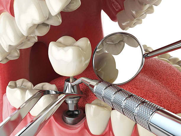 Best Emergency Dentist for Knocked-Out Tooth in Ome, GA